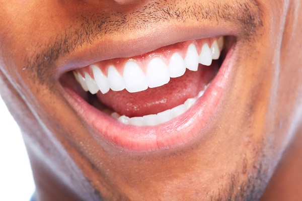 How A Dental Crown Smile Makeover Can Improve Tooth Flaws