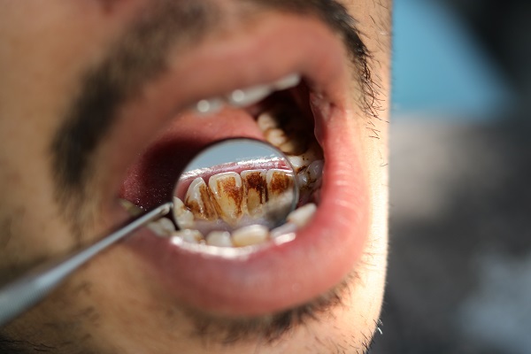 Tooth Decay Encino, CA